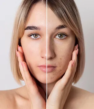 Manchas (Clareamento) - Badra Medicina e Estética