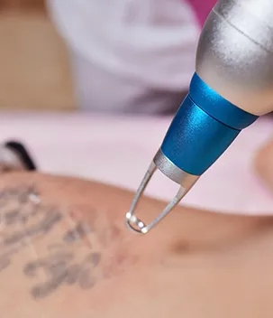 Remoção de tatuagem a laser - Badra Medicina e Estética